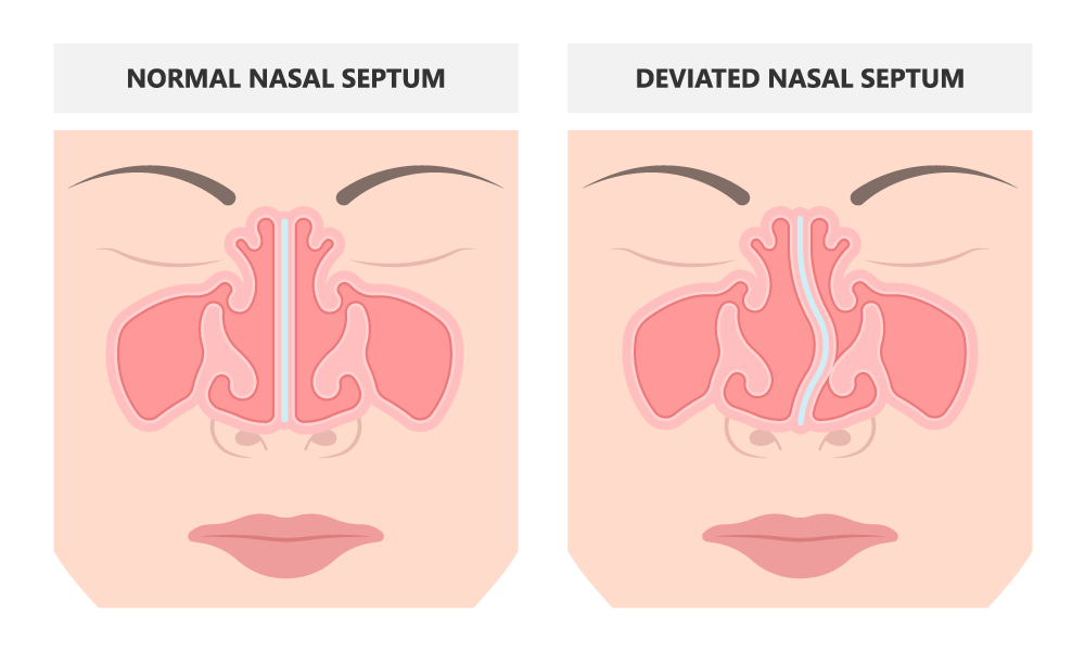 Illustration of normal nasal septum vs. deviated nasal septum