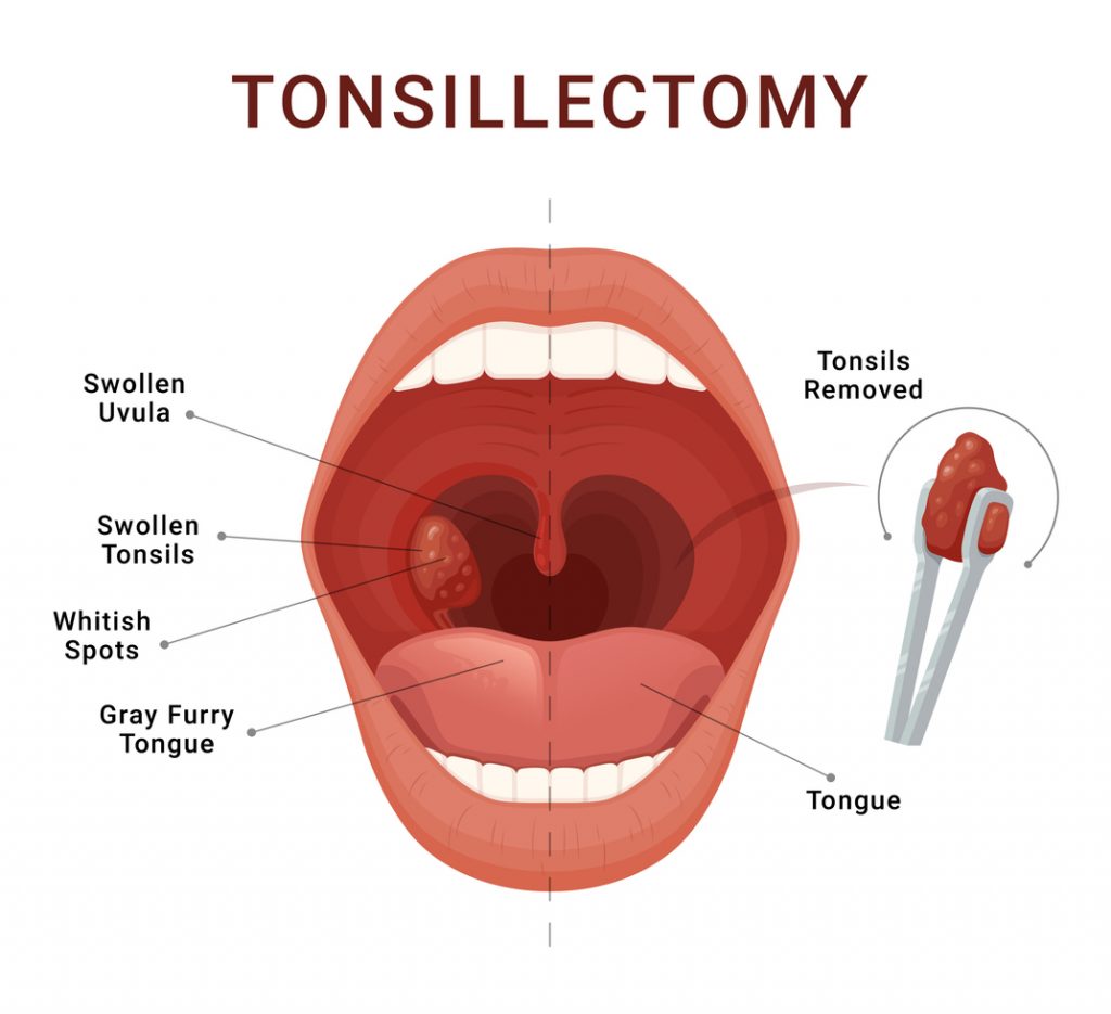 Tonsillectomy illustration