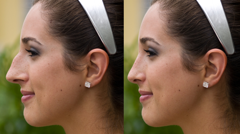 Rhinoplasty: Before and after