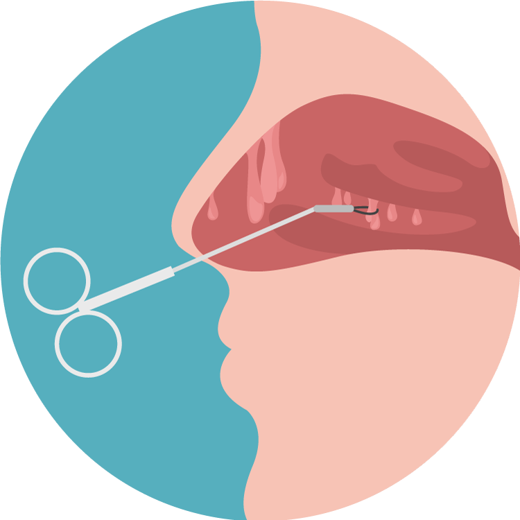 Simple graphic show nasal polyp surgery.