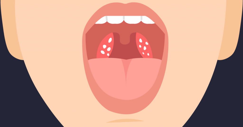 Illustration of tonsil stones